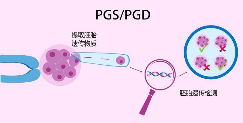 试管婴儿胚胎移植流程(试管婴儿胚胎移植全程解析)